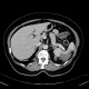 Splenic infarction, development in time: CT - Computed tomography